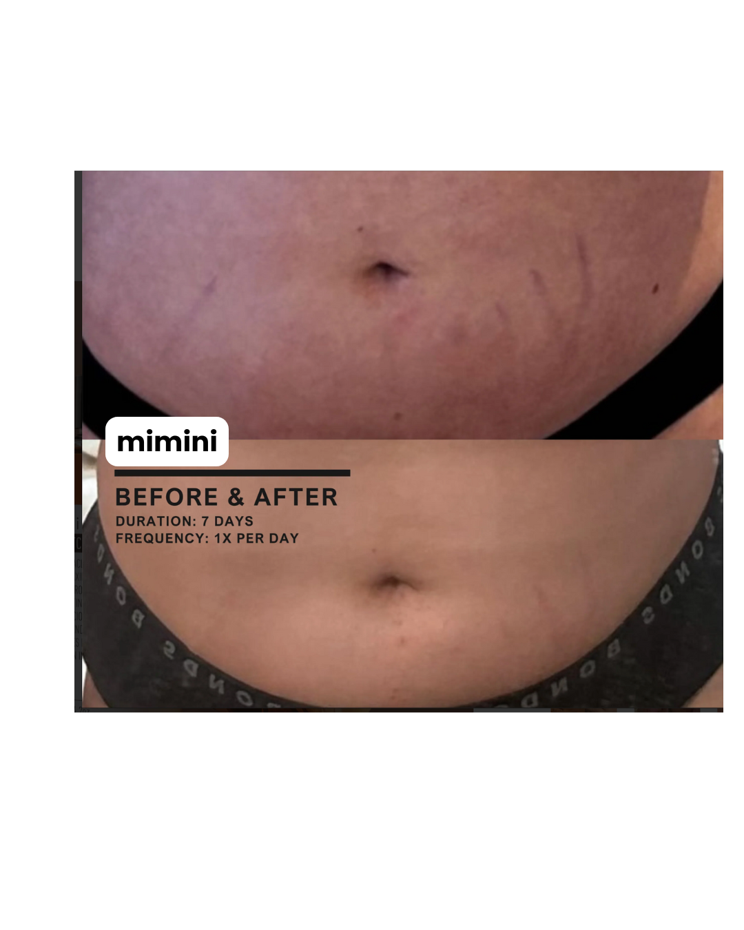 Stretch Mark Treatment Oil