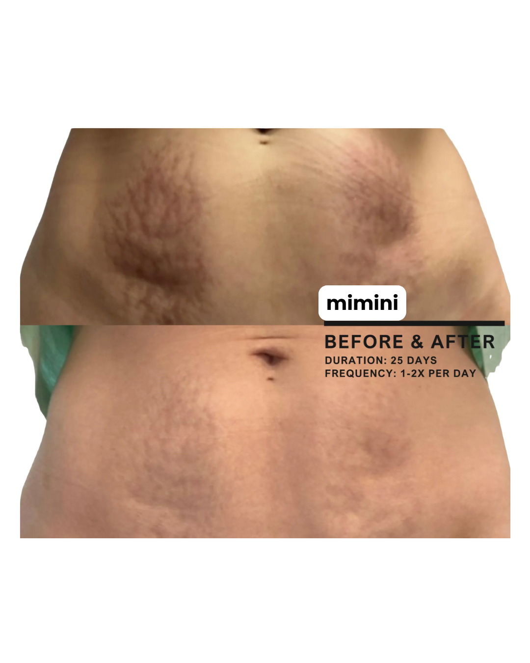 Stretch Mark Treatment Oil